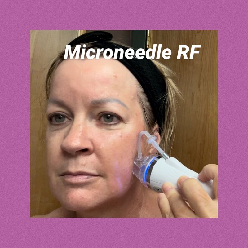 Microneedling with Radio Frequency for Dull Skin